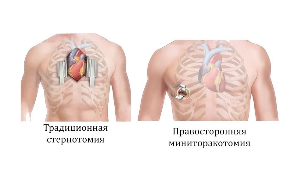 В Ярославле впервые провели операции на открытом сердце по мини-инвазивной технологии